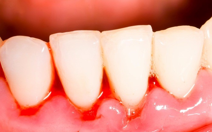 Chảy máu ở chân răng là dấu hiệu bệnh lý nha khoa xảy ra phổ biến ở nhiều người