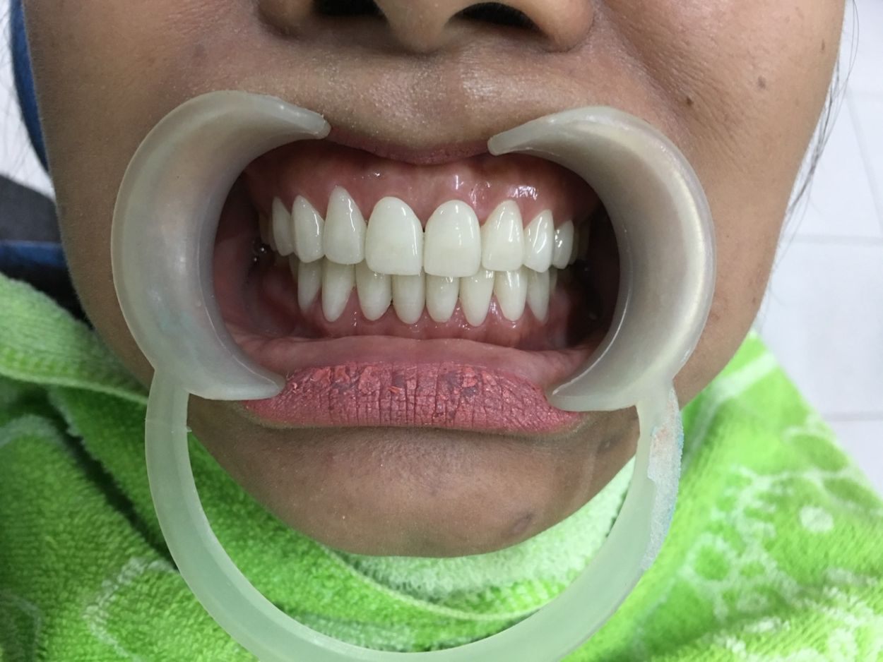 Hình ảnh Mặt dán răng sứ Veneers - nụ cười hoàn hảo