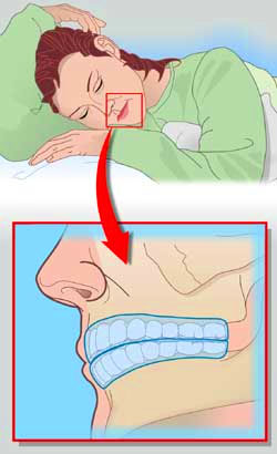 Tác hại của bệnh nghiến răng