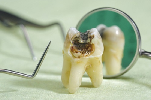 Nhổ răng sâu có chi phí đa dạng tùy vào loại răng