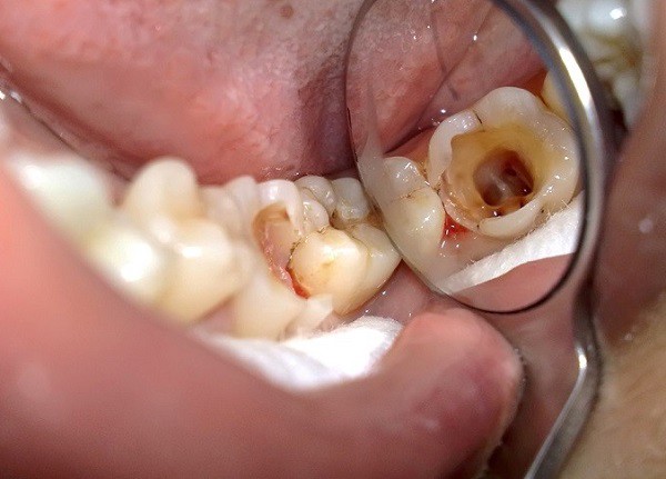 Răng sâu gây ra rất nhiều vấn đề về sức khỏe răng miệng