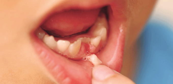 Nếu không để ý răng vĩnh viễn có thể bị mọc lệch, mọc chậm trước khi răng sữa rụng đi