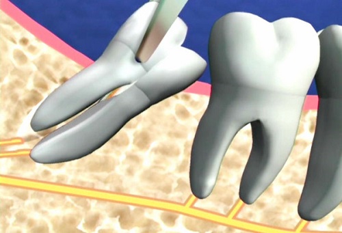 Răng khôn mọc lệch có thể làm tổn thương đến các răng mọc kế cận