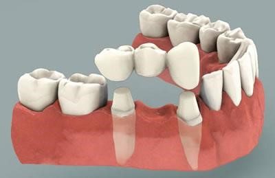 Trong trường hợp trồng răng implant không thành công, có thể làm gì?
